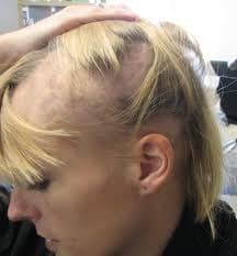 Movehs - Alopecia areata